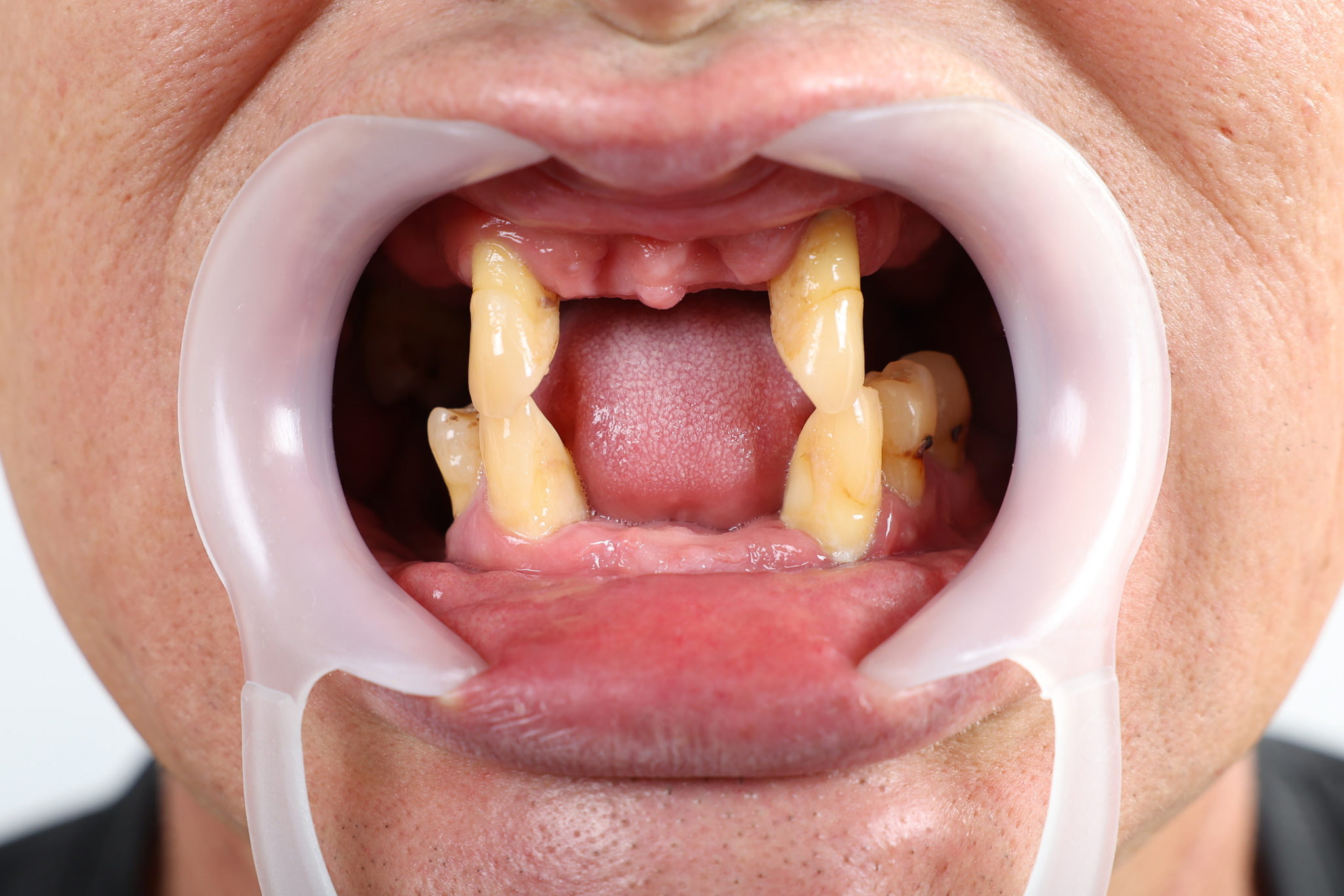 Before All-on-6 Implant Treatment